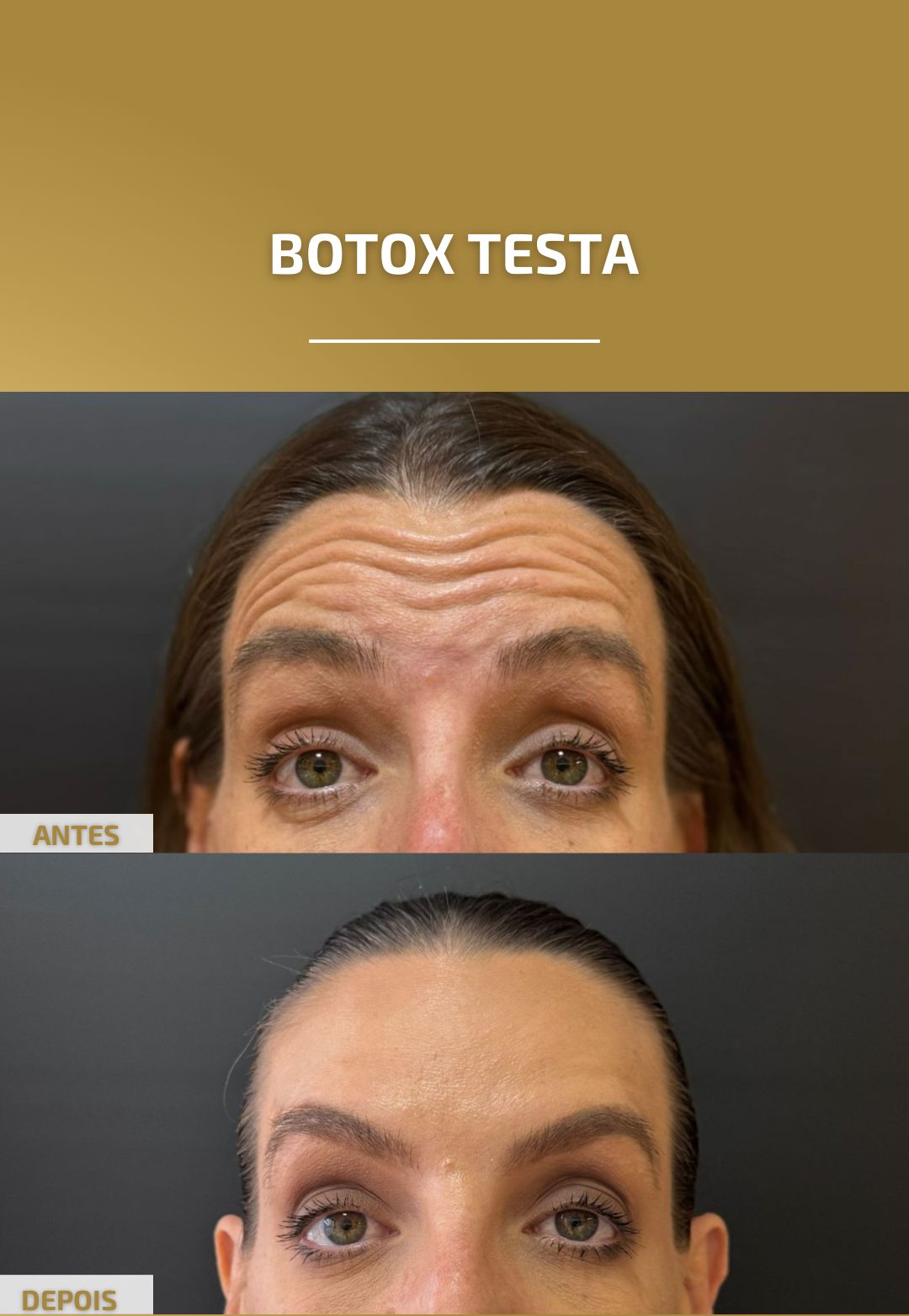 botox testa