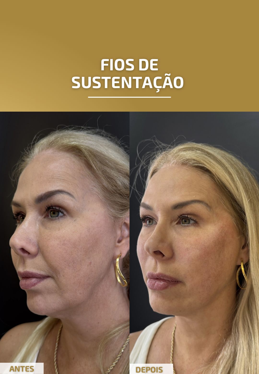 fios de sustentação 22