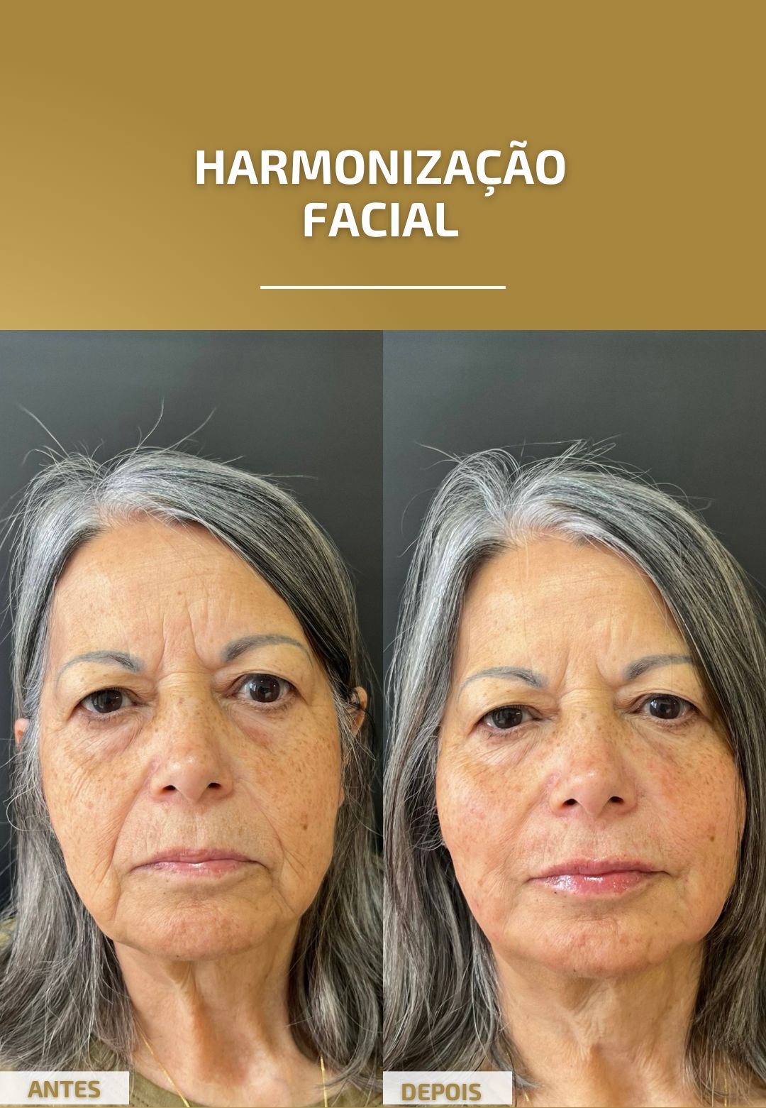 harmonização facial